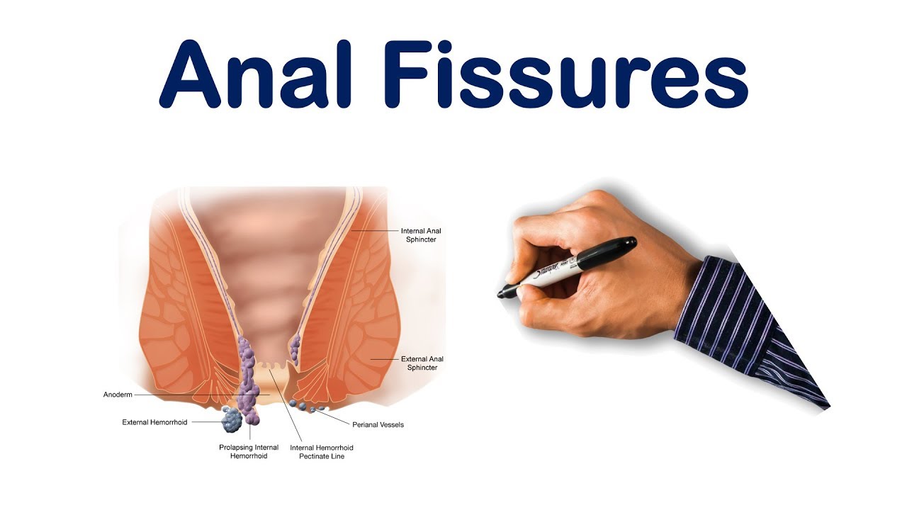What Are The Cause And Symptoms Of Fissure?